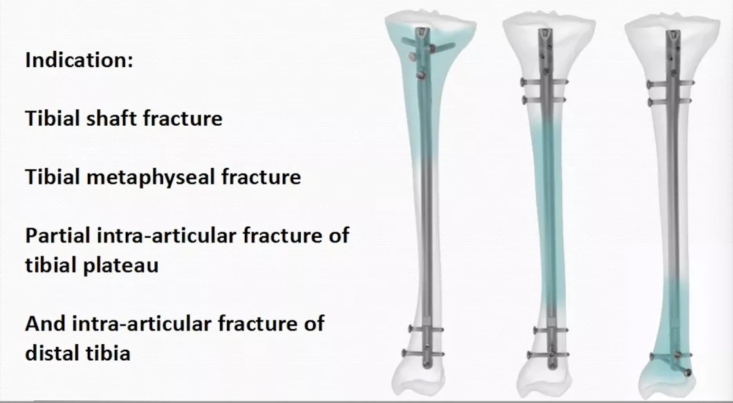 Orthopedic Implant Trauma Pure Titanium Surgical Bone Adult Medical Supply Product ISO CE Without Ethylene Oxide Sterilization Interlocking Intramedullary Nail